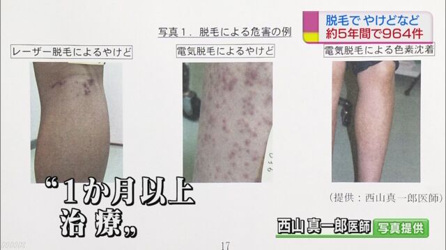 病院などで毛を抜くときはやけどなどの危険がある