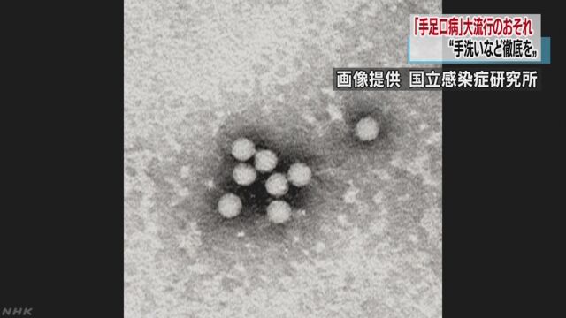 手足口病の子どもがとても増えるかもしれない